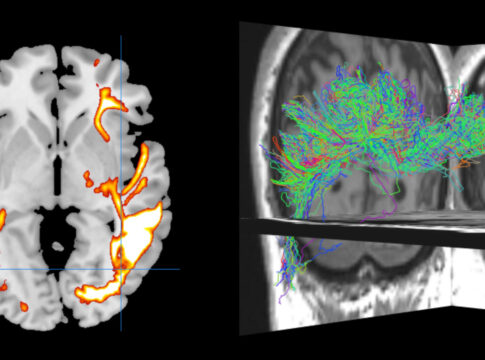 brain_and_disconnections
